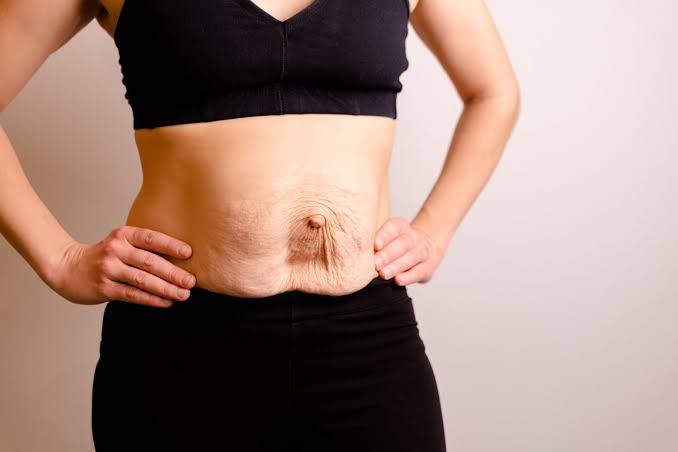 Is Surgery Really the Only Way to Repair Diastasis Recti Edinburgh?