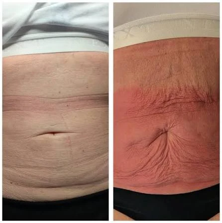 How Does RF Microneedling Improve Crepey, Thin and Uneven Skin Texture Edinburgh?