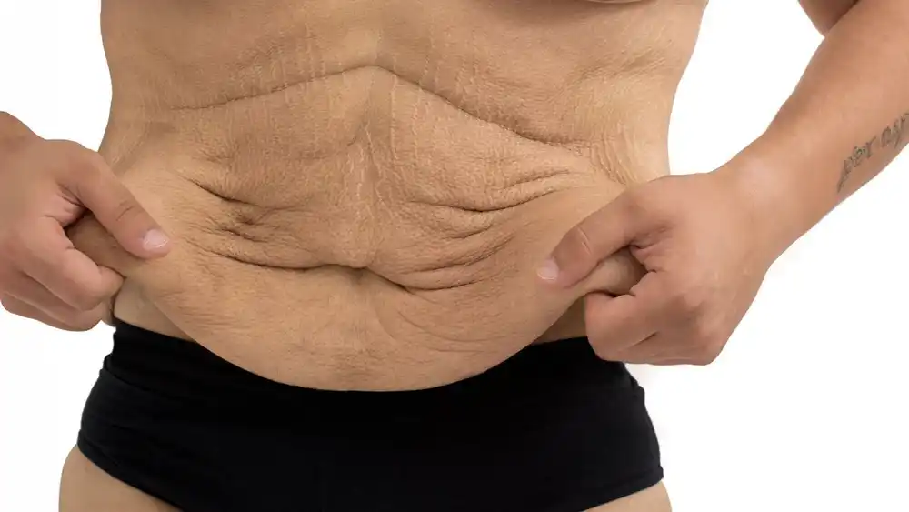 RF Microneedling for Loose Skin: How Can It Help Tighten and Reshape the Skin Edinburgh?
